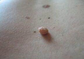 Papilloma cilt yüzeyinde bir büyümedir